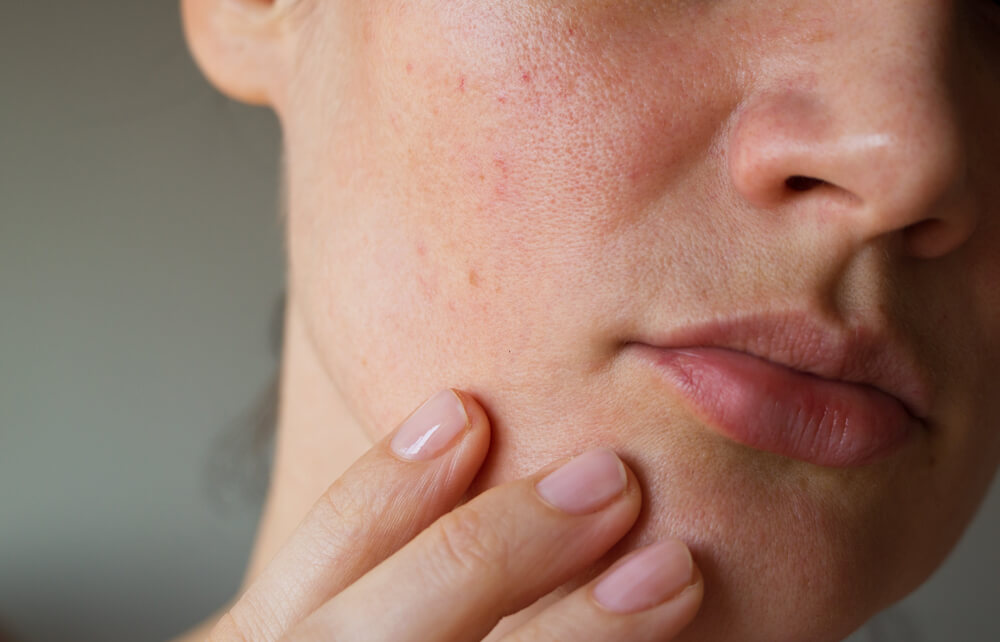 How to Get Rid Blackheads in Oily Skin Skin to Love Clinic